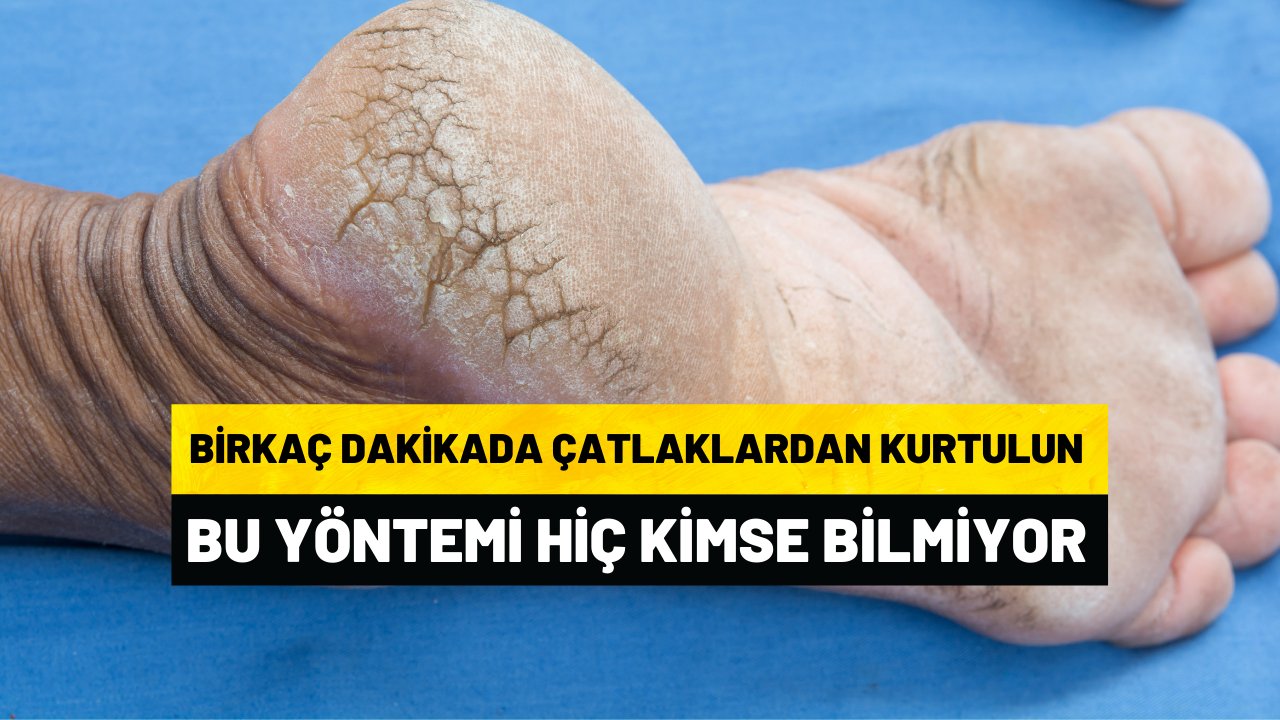 Topuklarındaki çatlaktan bu yöntemle kurtuldular